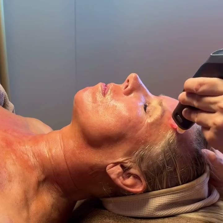 Microneedling met de AxionPen langs het voorhoofd